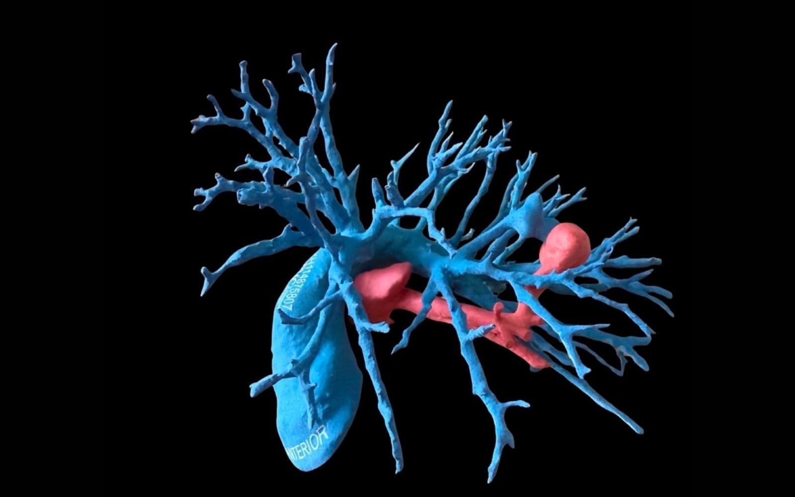 Cercetători de la UPMC și UCSF folosesc modele 3D printate pentru planificarea embolizării malformațiilor vasculare pulmonare
