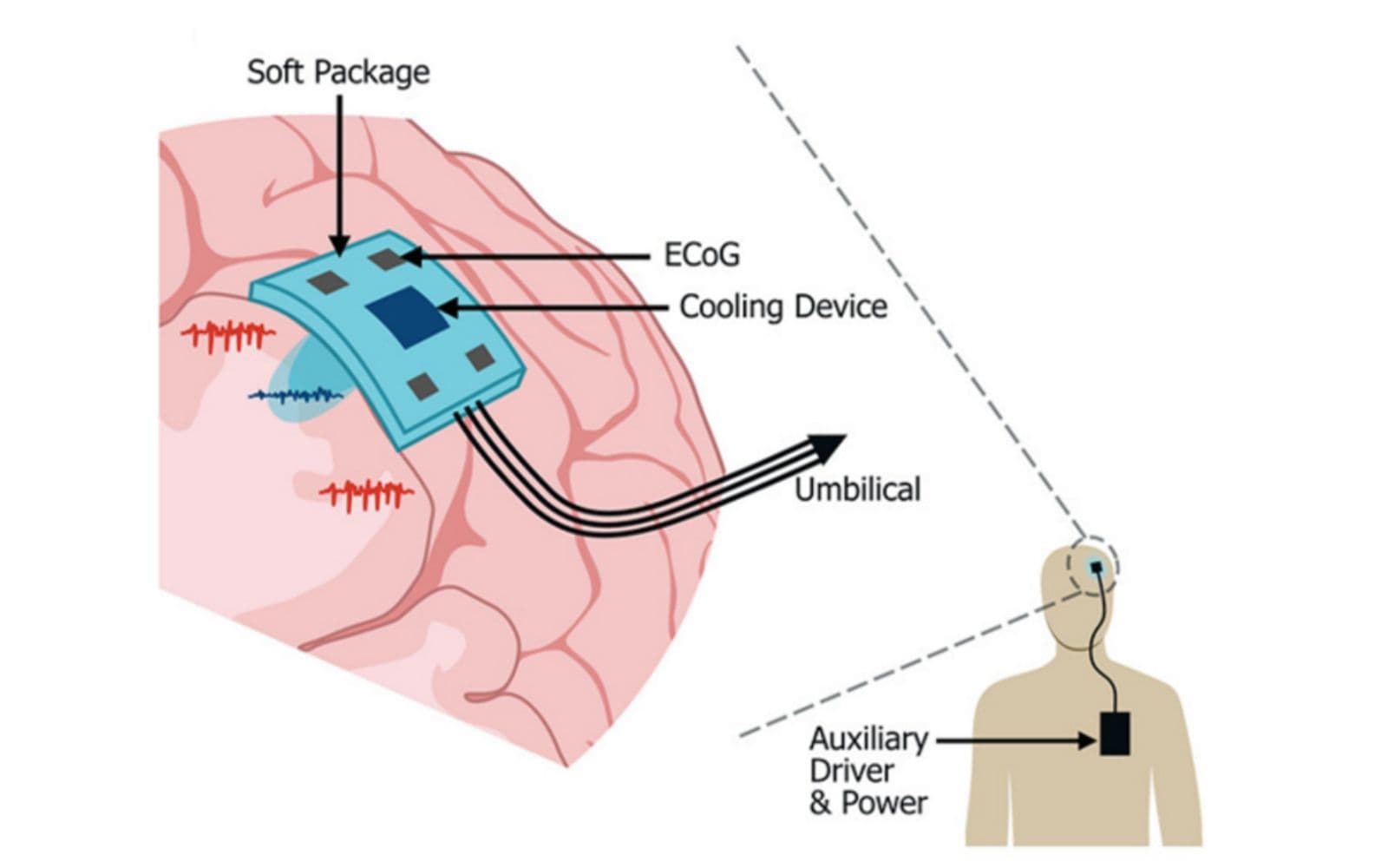 IPF și TU Dresda dezvoltă un implant cerebral imprimat 3D care înregistrează și răcește